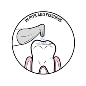 in pits and fissures