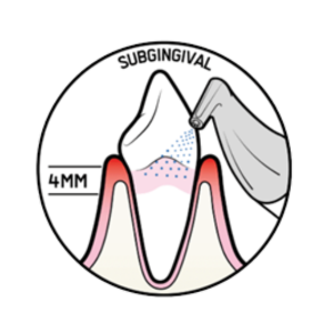 Subgingival