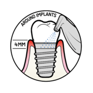 around implants